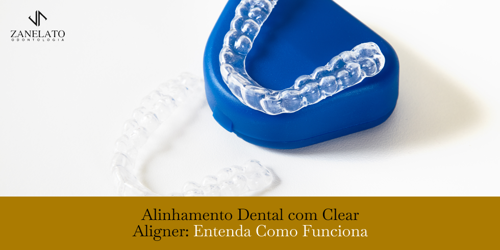 Alinhamento Dental com Clear Aligner: Entenda Como Funciona