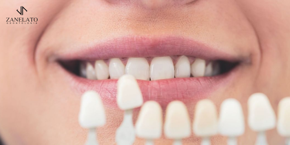Zanelato Estética Dental | Tratamentos Odontológicos e Odontologia Digital Reabilitação Adesiva: Entenda o Procedimento de Porcelana Zero Desgaste