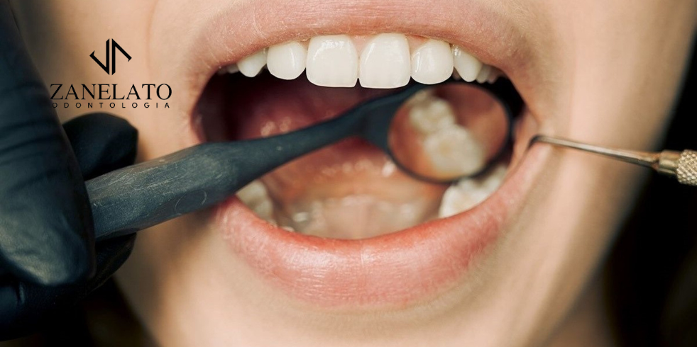 Zanelato Estética Dental | Tratamentos Odontológicos e Odontologia Digital Implantes Dentários: Quais os Procedimentos Necessários?