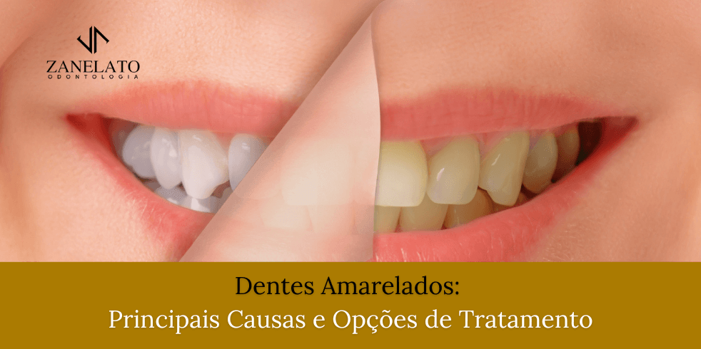 Dentes Amarelados: Principais Causas e Opções de Tratamento