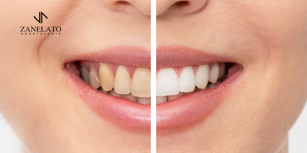 Dentes Amarelados: Principais Causas e Opções de Tratamento
