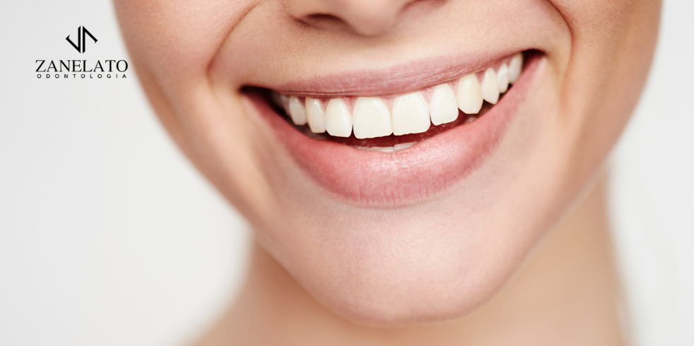 Lentes Dentais: Transforme Seu Sorriso
