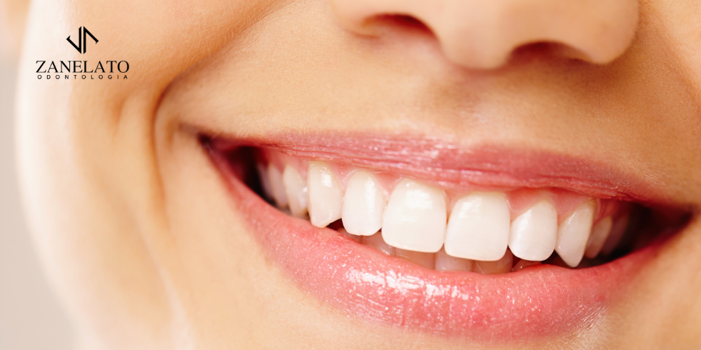 Lentes Dentais: Transforme Seu Sorriso
