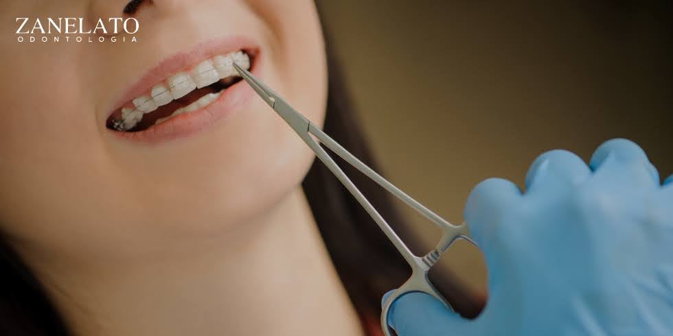 Zanelato Estética Dental | Tratamentos Odontológicos e Odontologia Digital Benefícios e Indicações das Lentes de Contato Dental